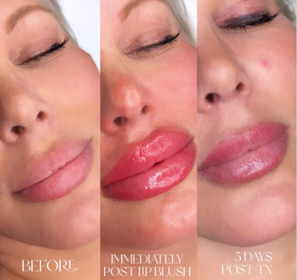Injecteerbare Vullers van Skinject de Diepe Hyaluronic Zure Huid2ml Lippen