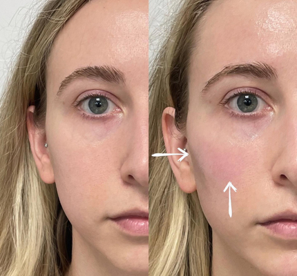 Injecteerbare Vullers van Skinject de Diepe Hyaluronic Zure Huid2ml Lippen