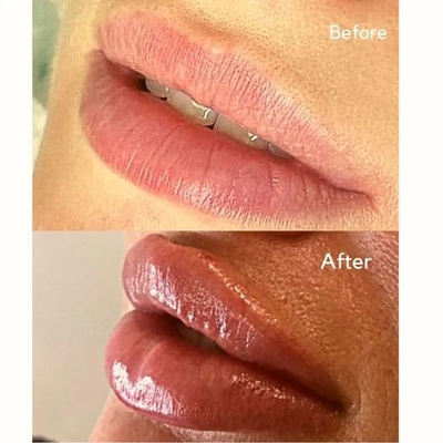 De injecteerbare van de Vullerinjectie Ultra 3 Ha Huidvuller van Juvederms voor Lippenvolume