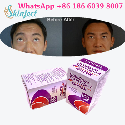 Botulinum Toxine Allergan s 1x100iu voor Gezichtsrimpels