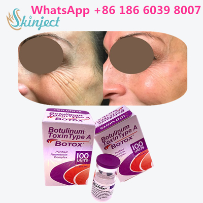 Botulinum Toxine Allergan s 1x100iu voor Gezichtsrimpels