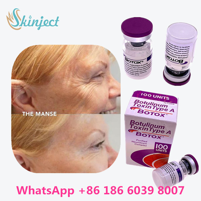 allergan botulinum toxine Anti het Verouderen Productentype A Toxine Antirimpel