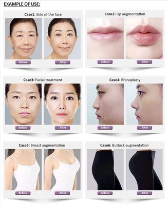 Hyaluronic Huidvuller van 1.1ml Revolax de diep voor Gezicht