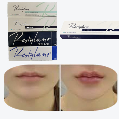 Hyaluronzuur huidvuller voor borstlippenvergroting