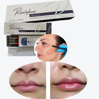 Dermale vulmiddel Lip Injecties Koreaanse originele authentieke producten Lip Natrium Hyaluronate Filler