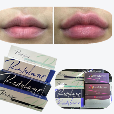 2*1 ml/doos Hyaluronzuur huidvuller voor lippenvergroting