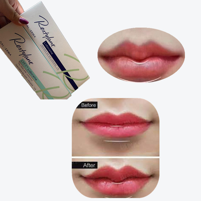 2*1 ml/doos Hyaluronzuur huidvuller voor lippenvergroting