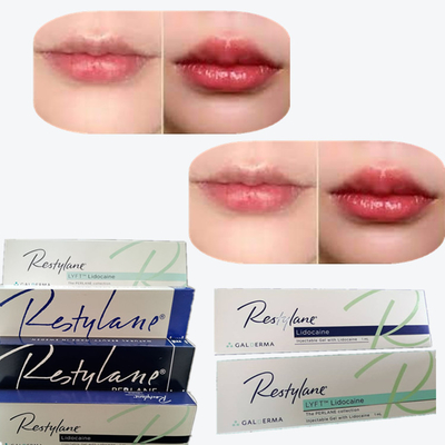 2*1 ml/doos Hyaluronzuur huidvuller voor lippenvergroting