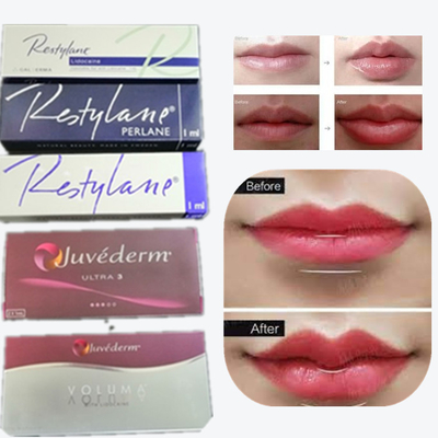 2*1 ml/doos Hyaluronzuur huidvuller voor lippenvergroting