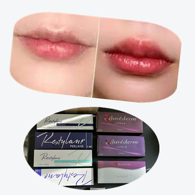 2*1 ml/doos Cross Linked Dermal Filler voor lippenvergroting