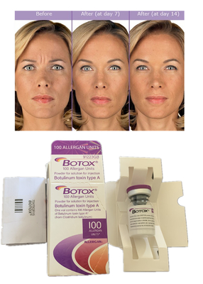Allergan Botulax  Botulinum Toxin 100IU Anti Wrinkles Dermale Filler