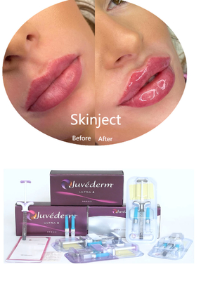 Juvederm Hyaluronzuur Gezichtsfilter voor huidbehandeling Injecteerbaar 2*1 ml Verpakking
