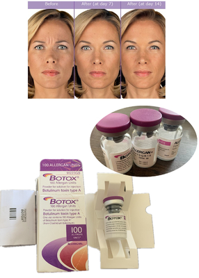 Anti-rimpel  Botulinum Toxin Allergan 100IU 150iu ' Na