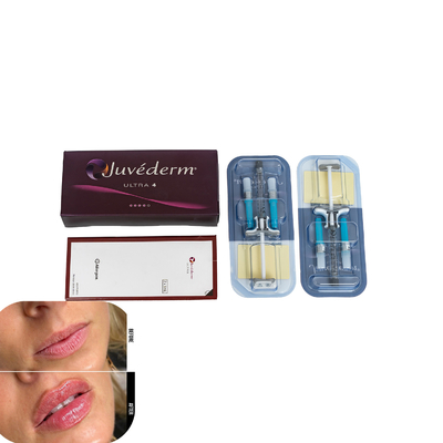 Juvederm huidvuller voor lippen injectievullers met hyaluronzuur