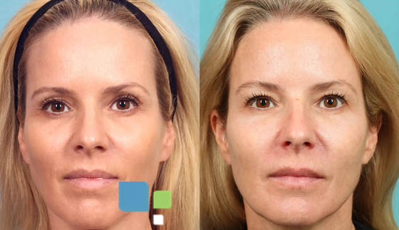 3D PLLA injectievuller voor gezichtscollageenregeneratie
