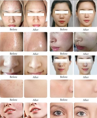 Nieuwe aankomst Black Pearl 10 in 1 Hydra Peeling Machine Microdermabrasie Machine Gezichtsspa Micro-Touch Hydra Huidverzorging