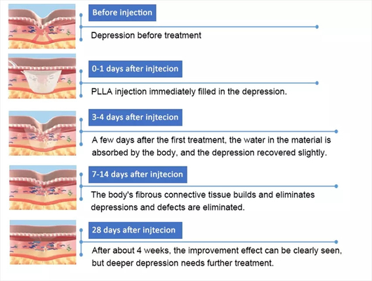 PLLA Poly- L- melkzuur gezichtsinjectie 10 injectieflaconen 150 mg