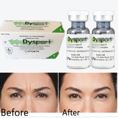 Botulinum Toxin Dysport Anti-Wrinkle Poeder Vriesgedroogd Poeder Voor Glabellaire Lines