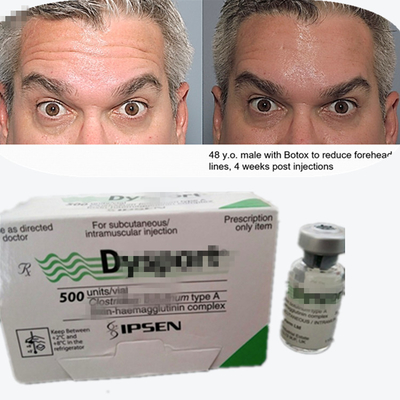 Botulinum Toxin Dysport Anti-Wrinkle Poeder Vriesgedroogd Poeder Voor Glabellaire Lines