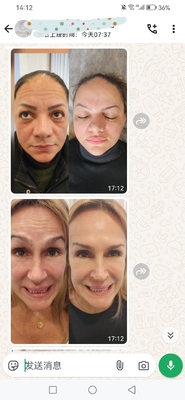 Cosmetische Dysport 500 Eenheden Botulinum Toxin 500 IE poeder voor injectie