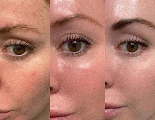 Collageenstimulatie Profhilo injecteerbare huidvuller Vijfpuntslifting