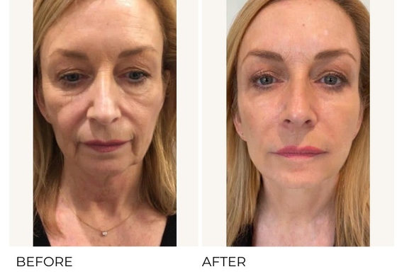 Anti-aging en rimpelverwijdering Profhilo H L 2 ml hyaluronzuur met een concentratie van 32 mg/ml Ha