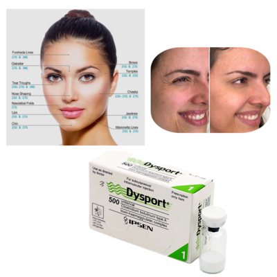 Dysport 500U Botulinum Toxin Type A voor de behandeling van rimpels
