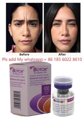 Botulinetoxine Allergan Botox 100IE Injectie - Verminder verouderingstekenen met Allergan