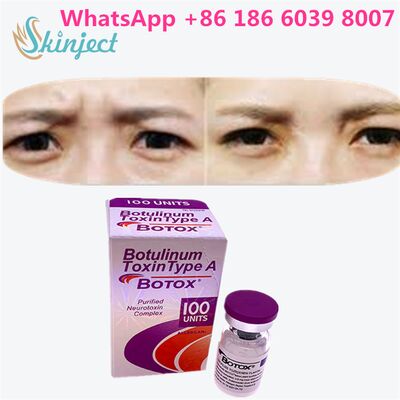 Botulinumtoxine ALLERGAN BOTOX Duur 4 tot 6 maanden 100 Eenheden Type A