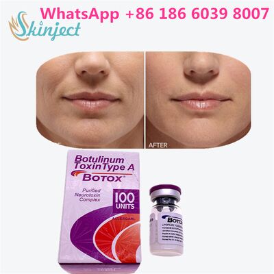 Botulinumtoxine ALLERGAN BOTOX Duur 4 tot 6 maanden 100 Eenheden Type A