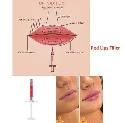 Onmiddellijke hersteltijd Revolax Deep Filler Uitstekend voor lipvergroting Biedt natuurlijke resultaten en minimale downtime