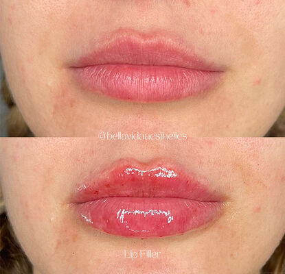 Houdbaarheidsduur 2 jaar Dermale vulmiddel injecteerbare gel ontworpen voor rimpelvermindering, gezichtscontouren en huidrevitalisatie