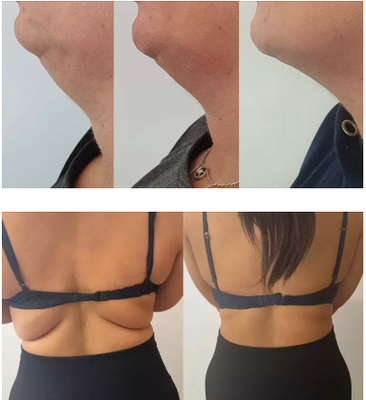 Lemon Bottle Weight Loss Lipolytische oplossing voor dubbele kin, buik