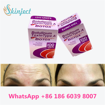 Botulinum Toxin Allergan BOTOX Cosmetische injectie 100 Eenheden voor Glabellaire lijnen