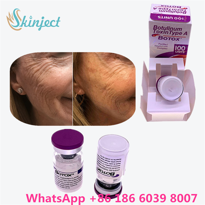 Botulinumtoxine Allergan Botox Wit Poeder Effectieve Behandeling voor Gezichtslinjnen en Spierontspanning in Medisch Gebruik