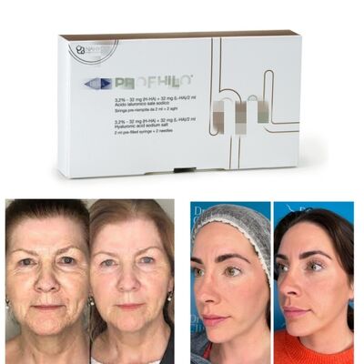 Profhilo Behandeling Hyaluronzuur Huid Booster & Bio-Remodeling