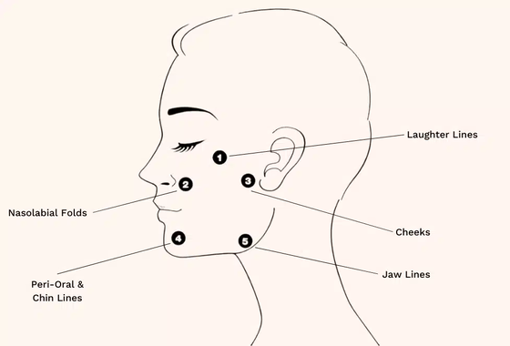 Profhilo Behandeling Hyaluronzuur Huid Booster & Bio-Remodeling