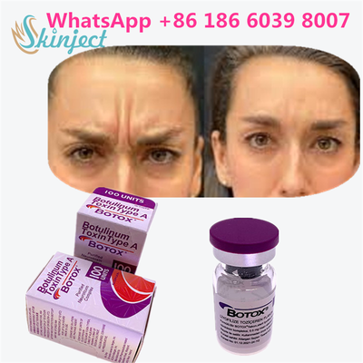Botulinumtoxine BOTOX Cosmetisch 100 Eenheden Allergan OnabotulinumtoxineA voor Gezichtrimpels