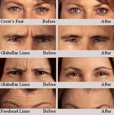 Hyamely Premium Botulinum Toxin Type A voor injectie