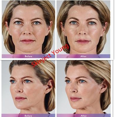 Hyaluronic Zure Injecteerbare het Gelvullers van Juvedermvoluma 2x1ml