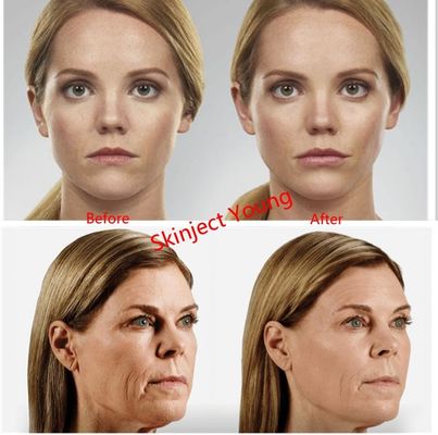 Hyaluronic Zure Injecteerbare het Gelvullers van Juvedermvoluma 2x1ml