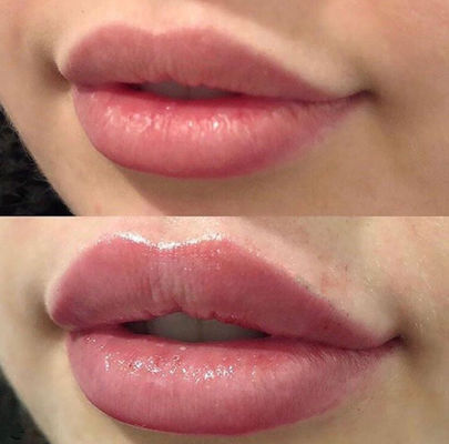 Russische Lippen Juvederm ultra 3 met  Kruis Verbonden Huidvuller