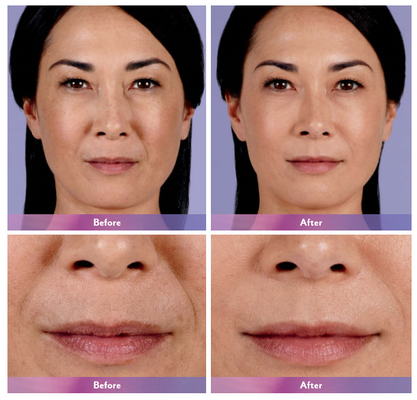 De Lippeninjectie ultra 4 van de Juvederm Huidvuller voor Lippenuitbreiding