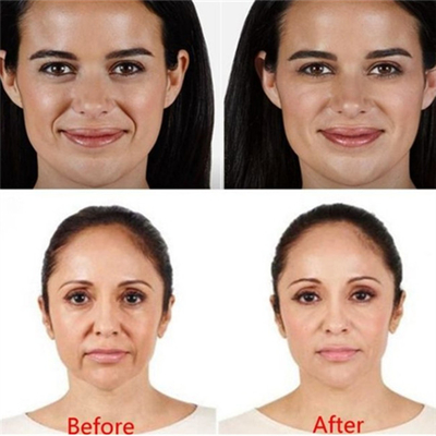Van de de Vullerlip van Ha 2ml de Huid van de de Injectiesrimpel Vuller Injecteerbare Juvederm
