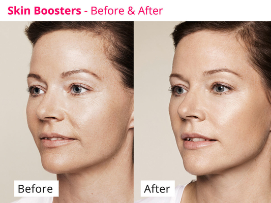 Huid die het Meso Serum van PDRN Skinbooster voor Collageenregeneratie verjongen
