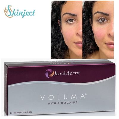 De Huidvullers van Juvedermvoluma 2x1ml Ha voor Jukbeen Chin Contouring