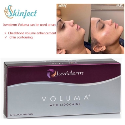 Hyaluronic Zure Huidvullers van Juvedermvoluma 2x1ml voor Jukbeen