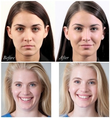 Hyaluronic Zure Gezichtsvuller van Juvedermsvoluma voor Kin en Wangvergroting