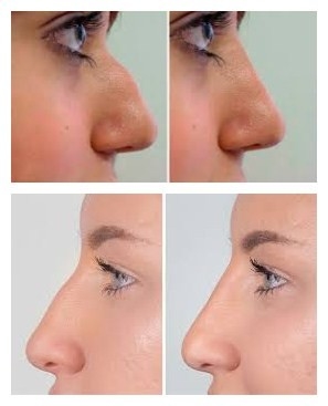 Hyaluronic Zure Gezichtsvuller van Juvedermsvoluma voor Kin en Wangvergroting
