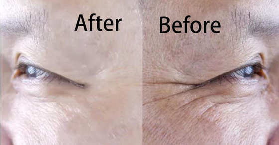Het Hyaluronic Zure de Regeneratie van het Vullercollageen Witten en Anti het Verouderen Injectie